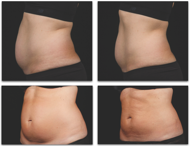 Efekty wyszczuplania sylwetki laserem Sculpsure - przed i po zabiegu Wyszczuplanie ciała i modelowanie sylwetki laserem Sculpsure Klinika Miracki