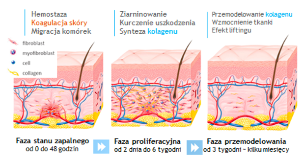 Zabieg Ultraformer III - nieinwazyjny lifting