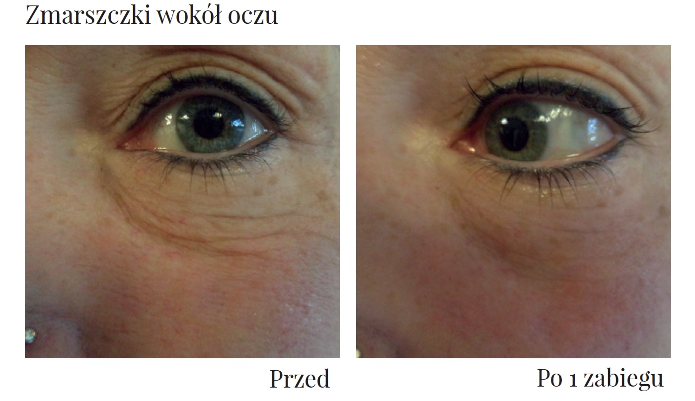 Efekty zabiegu Ultraformer III w okolicy oczu Klinika Miracki