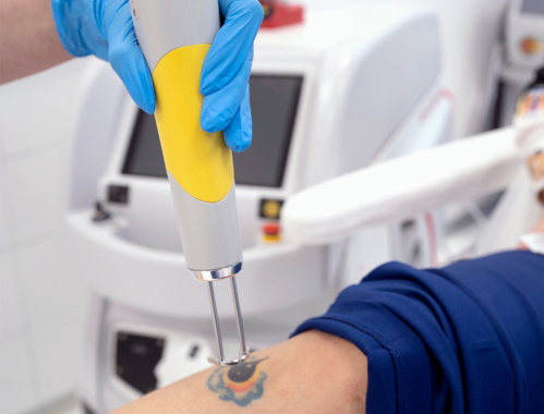 Co to jest laser Pikosekundowy? Eksperci z naszej łódzkiej kliniki odpowiadają