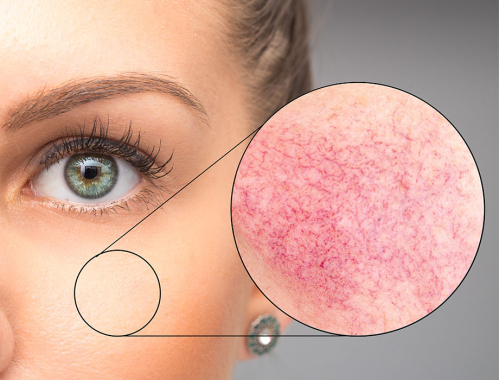 Zastanawiasz się jak wygląda rumień? ✹ Sprawdź porady naszych ekspertów z kliniki w Warszawie i zapisz się na zabieg! Zapraszamy też do naszych klinik w Katowicach, Łodzi i Krakowie.