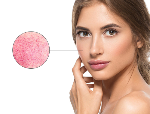 Zastanawiasz się co to jest rumień? Jak pozbyć się zaczerwienienia ze skóry? ✹ Sprawdź porady naszych ekspertów z kliniki w Warszawie, Krakowie, Łodzi, Katowicach i zapisz się na zabieg!