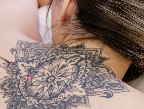 Jesteś z Łodzi i chcesz usunąć niechciany tatuaż, przyjdź do Kliniki Miracki. Nasi specjaliści czekają!