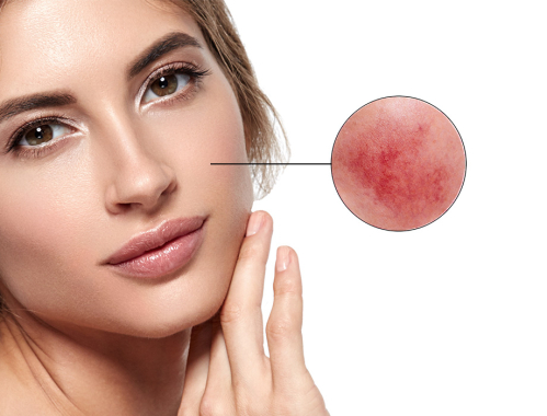 Ile kosztuje laserowe usuwanie trądziku w Krakowie?