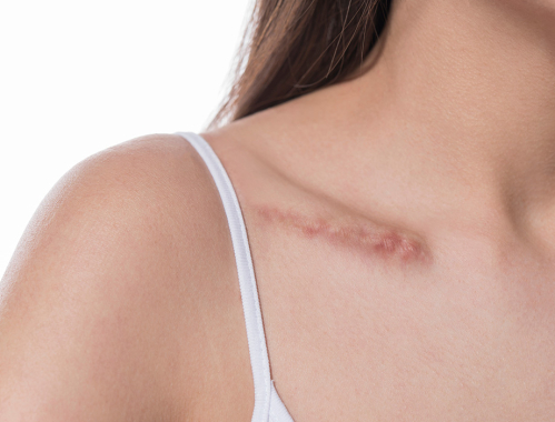 Masz blizny pourazowe, pooperacyjne lub potrądzikowe i szukasz sposobu, by się ich pozbyć? Przyjdź do Kliniki Miracki w Łodzi!