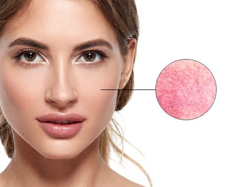 Zastanawiasz się jak leczyć rumień? ✹ Sprawdź porady naszych ekspertów z kliniki w Warszawie, Krakowie, Łodzi lub Katowicach i zapisz się na zabieg!