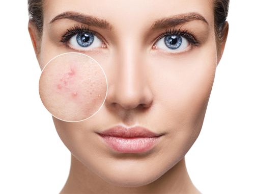 Nie wiesz, jak leczyć trądzik hormonalny? Dowiedz się, jakie zabiegi na trądzik wybrać i odwiedź naszą Klinikę w Krakowie. Zapraszamy też na zabiegi w naszych klinikach w Warszawie, Łodzi, Katowicach.