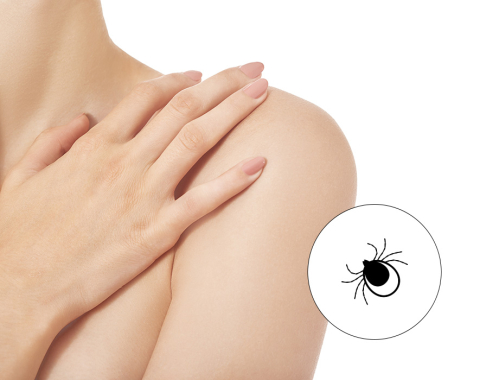 Zastanawiasz się czy rumień to zawsze borelioza? ✹ Sprawdź porady naszych ekspertów z kliniki w Warszawie, Krakowie, Łodzi i Katowicach i zapisz się na zabieg!