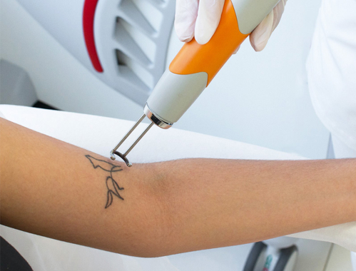 Ile kosztuje laserowe usuwanie tatuażu w Łodzi?