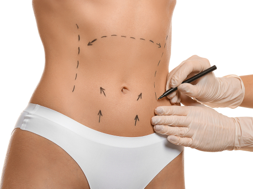 Jesteś ciekawa, czy liposukcja laserowa zostawia blizny? Dowiedź się, czy redukcja tkanki tłuszczowej tą metodą pozostawia ślady na skórze!