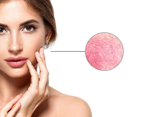 Zastanawiasz się czym się jak leczyć rumień na twarzy? ✶ Umów się na konsultację z lekarzem medycyny estetycznej w naszej klinice w Katowicach, Krakowie, Łodzi, Warszawie!