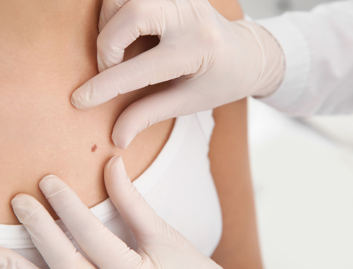 Masz brodawkę łojotokową? Dowiedz się, jakie zabiegu na brodawki łojotokowe pozwolą Ci pozbyć się tych zmian!