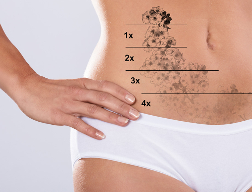 Zastanawiasz się ile zabiegów usuwania tatuażu należy wykonać? ✶ Umów się na konsultację w naszej klinice w Katowicach, Warszawie, Krakowie lub Łodzi!