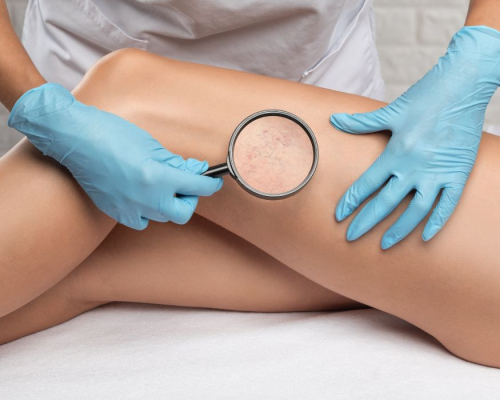 Ile kosztuje usuwanie żylaków laserem?