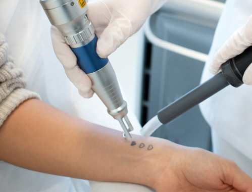 Mieszkasz w Katowicach i chcesz usunąć tatuaż lub makijaż permanentny? Przyjdź do Kliniki Miracki!