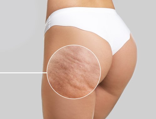 Zastanawiasz się, czy cellulit w ciąży zniknie po ciąży? ✹ Sprawdź porady ekspertów naszej kliniki w Warszawie, Krakowie, Łodzi czy Katowicach.