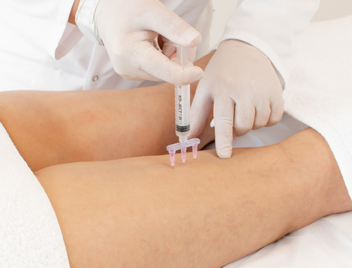 Zastanawiasz się nad mezoterapią na uda w celu usunięcia cellulitu? Zapisz się na zabieg w Krakowie, Warszawie, Łodzi lub Katowicach.