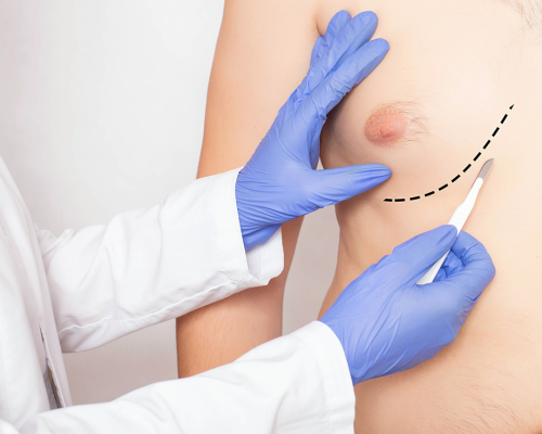 Jak rozpoznać ginekomastię?