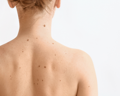 Niebezpieczne pieprzyki – kiedy warto udać się na konsultację lekarską?