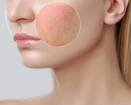 Jak usunąć nagły rumień na twarzy?
