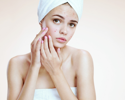 Jak wyleczyć trądzik krostkowy?