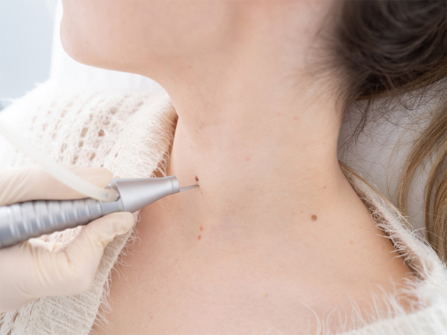 Nasi Lekarze wykonują zabiegi Laserowego usuwania zmian skórnych, dzięki którym pozbędziesz się pieprzyków, brodawek czy włókniaków. Sprawdź!