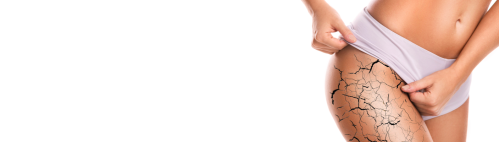 Szukasz skutecznej metody redukcji rozstępów? Zdecyduj się na laserowe usuwanie rozstępów w Klinice Miracki. Zapraszamy na zabiegi w naszych klinikach w Warszawie, Łodzi, Katowicach i Krakowie.