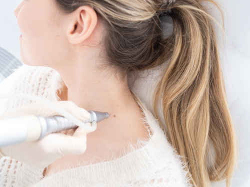 Usuwanie pieprzyków laserem czy chirurgicznie? Poznaj cały proces kwalifikacji do zabiegów usuwania wybranych zmian skórnych!