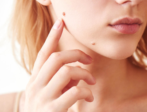 Masz pieprzyk i nie wiesz, czy możesz poddać się depilacji laserowej? Ekspert odpowiada! Pieprzyki a depilacja laserowa ◆ Warszawa, Katowice, Kraków, Łódź.