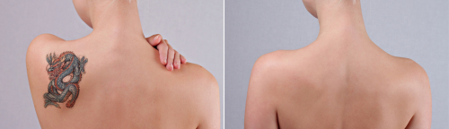 Lasery pikosekundowe - najskuteczniejsza metoda usuwania tatuażu, w tym tatuażu kolorowego. ▸ Dwa lasery pikosekundowe tylko w Klinice Miracki Warszawa, Katowice!