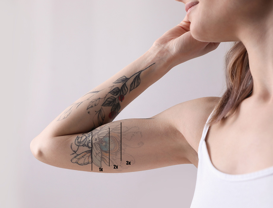 Zastanawiasz się jak działa laserowe usuwanie tatuażu? ✹ Sprawdź porady naszych ekspertów z kliniki w Katowicach, Krakowie, Łodzi czy Warszawie i zapisz się na zabieg!