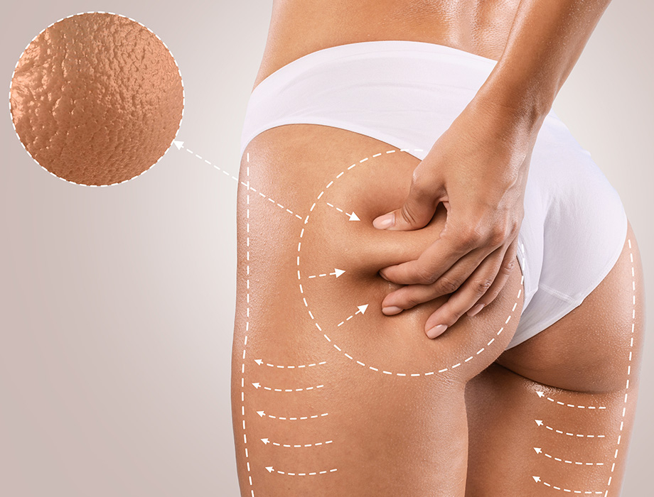 Zastanawiasz się, co jest dobre na cellulit? ✹ Sprawdź porady ekspertów naszej kliniki w Warszawie, Krakowie, Łodzi, Katowicach.