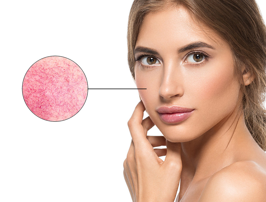 Zastanawiasz się co to jest rumień? Jak pozbyć się zaczerwienienia ze skóry? ✹ Sprawdź porady naszych ekspertów z kliniki w Warszawie, Krakowie, Łodzi, Katowicach i zapisz się na zabieg!