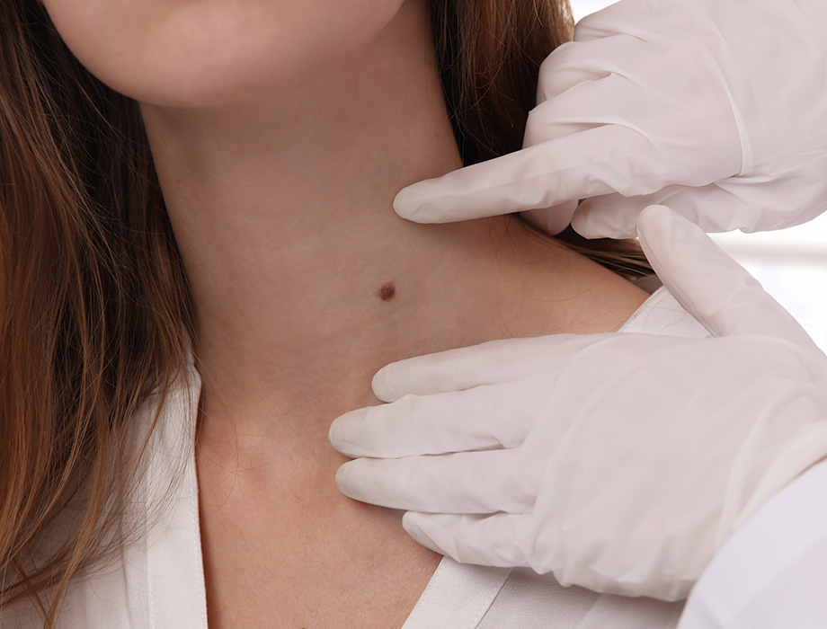 Chcesz pozbyć się nieestetycznych zmian skórnych, takich jak pieprzyki czy włókniaki? Zapraszamy do Kliniki Miracki w Łodzi!