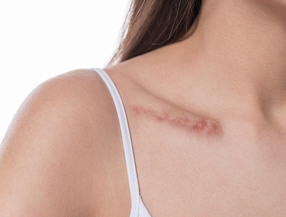 Masz blizny pourazowe, pooperacyjne lub potrądzikowe i szukasz sposobu, by się ich pozbyć? Przyjdź do Kliniki Miracki w Łodzi!