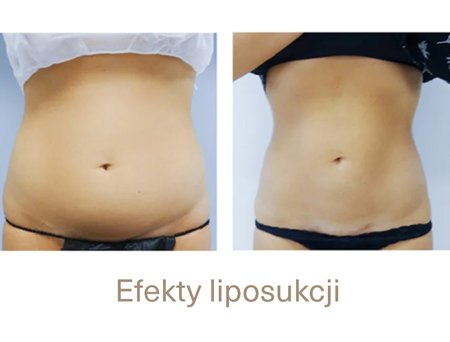 Zastanawiasz się ile kg można schudnąć po liposukcji? Zapisz się na konsultację w naszej klinice w Warszawie.