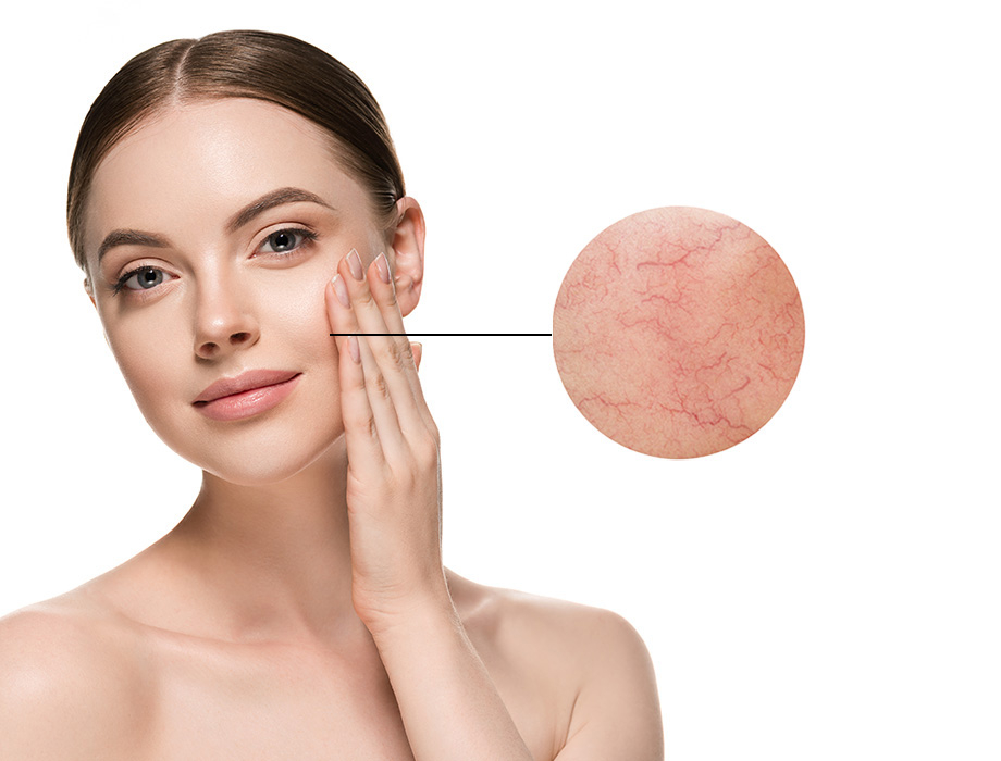 Ile kosztuje zabieg zamykania naczynek w Łodzi?