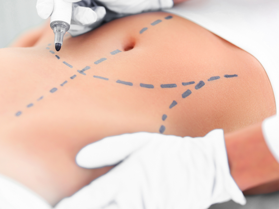 Nie wiesz, jakie zabiegi warto łączyć z liposukcją, aby skuteczniej pozbyć się nagromadzonej tkanki tłuszczowej? Dowiedz się, co radzą nasi specjaliści!