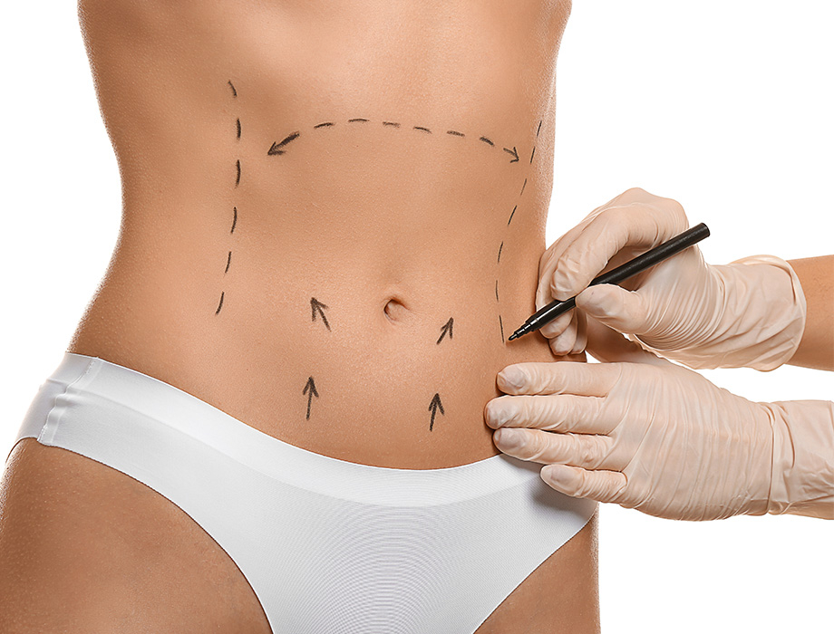 Chcesz szybko zmniejszyć obwód swojego brzucha? Przyjdź do Kliniki Miracki na profesjonalny zabieg odsysania tłuszczu!