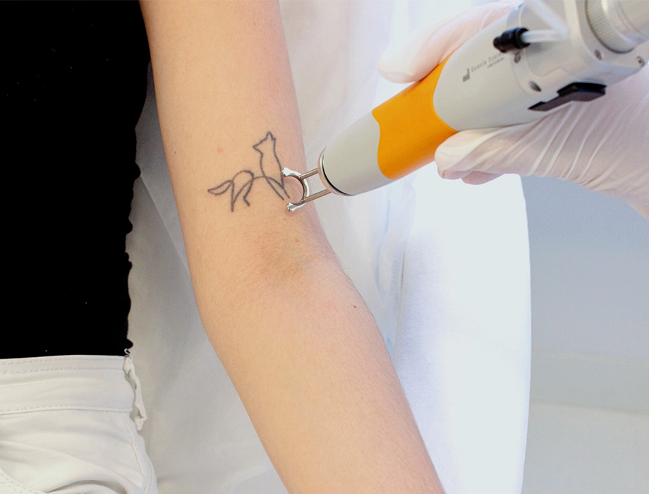 Laserowe usuwanie tatuaży – Łódź i okolice. Przyjdź do Kliniki Miracki!