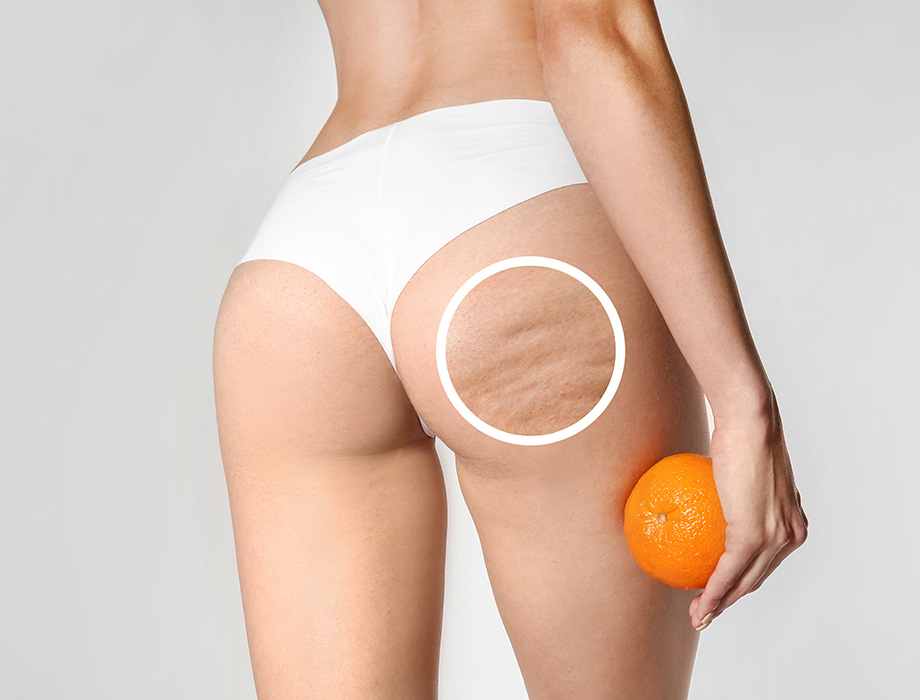 Zastanawiasz się, co to jest cellulit i jakie są jego przyczyny? ✹ Sprawdź porady ekspertów naszej kliniki w Katowicach, Warszawie, Krakowie czy Łodzi.