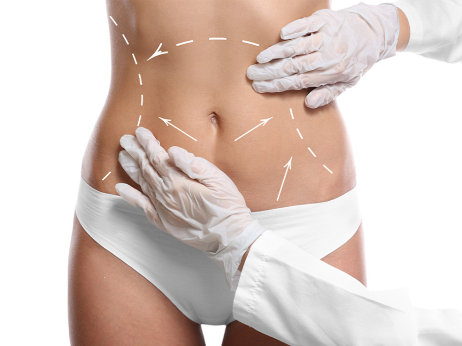 Czeka Cię zabieg liposukcji? Sprawdź, jak długo musisz nosić odzież uciskową po operacji. Poznaj zalecenia obowiązujące podczas rekonwalescencji!