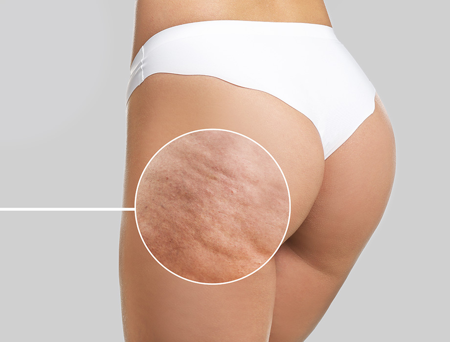 Zastanawiasz się, czy cellulit w ciąży zniknie po ciąży? ✹ Sprawdź porady ekspertów naszej kliniki w Warszawie, Krakowie, Łodzi czy Katowicach.