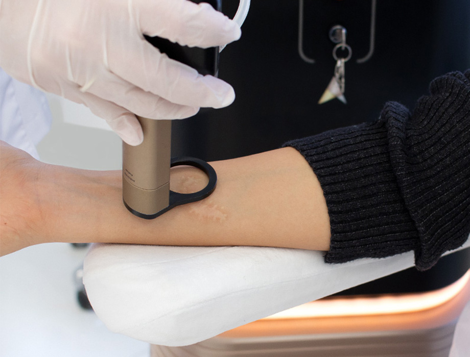 Mieszkasz w Katowicach i chcesz usunąć tatuaż lub makijaż permanentny? Przyjdź do Kliniki Miracki!