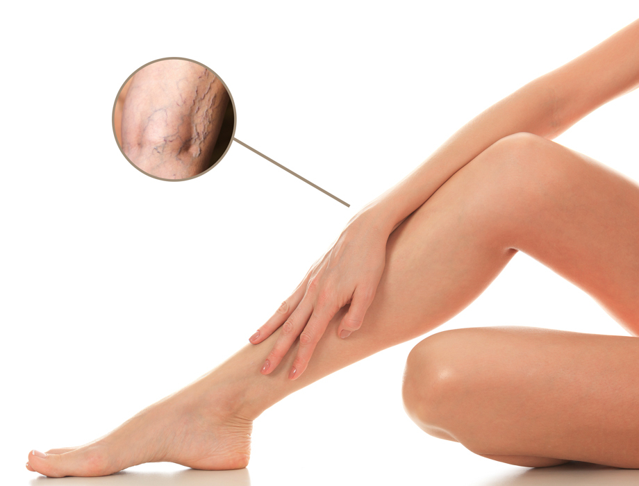 Nie wiesz, jaka jest cena usuwania żylaków różnymi metodami? Sprawdź, z jakim wydatkiem należy się liczyć i zadbaj o zdrowie żył!