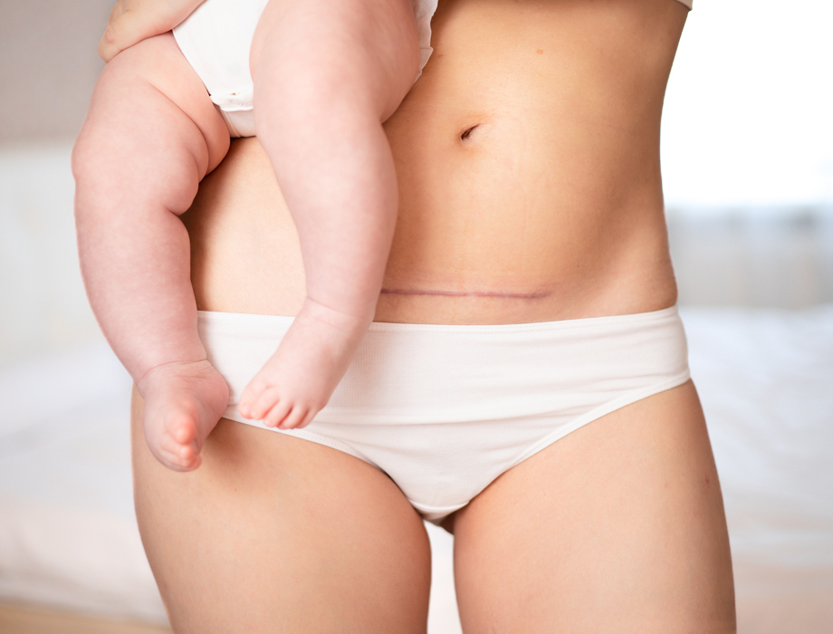 Jak usunąć fałdę nad blizną po cesarskim cięciu i bliznę po cesarce? Poznaj skuteczne sposoby na bliznę po CC, zrosty i nadmiar tłuszczu na brzuchu!