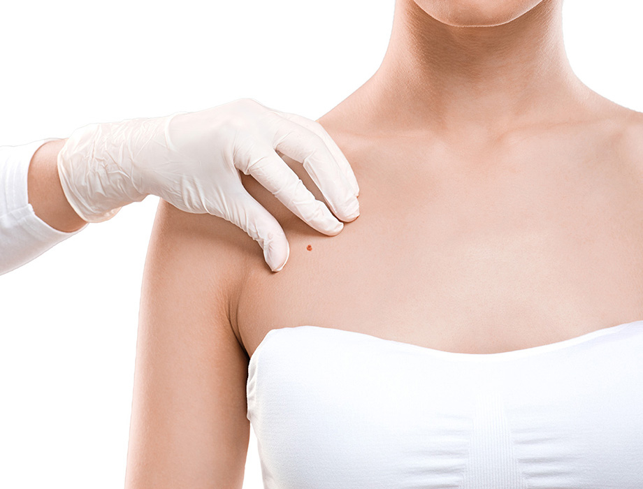 Jak wygląda włókniak i jak się go pozbyć?