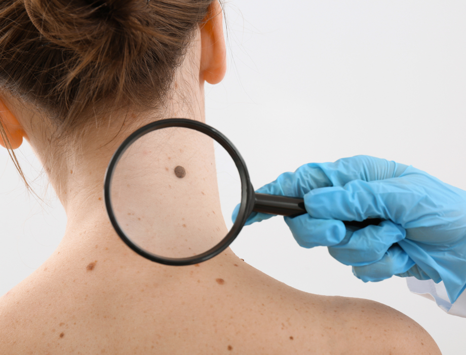 Usuwanie znamion to zabieg, który wykonuje się zarówno ze względów estetycznych, jak i zdrowotnych. Sprawdź, gdzie w Krakowie usunąć znamię.