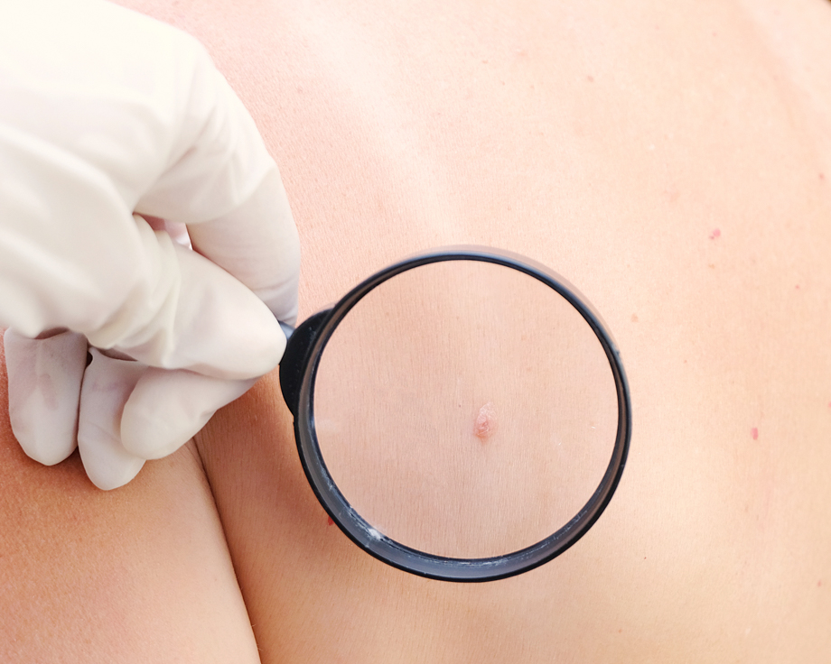 Czy każda narośl na skórze jest niebezpieczna? Ekspert odpowiada