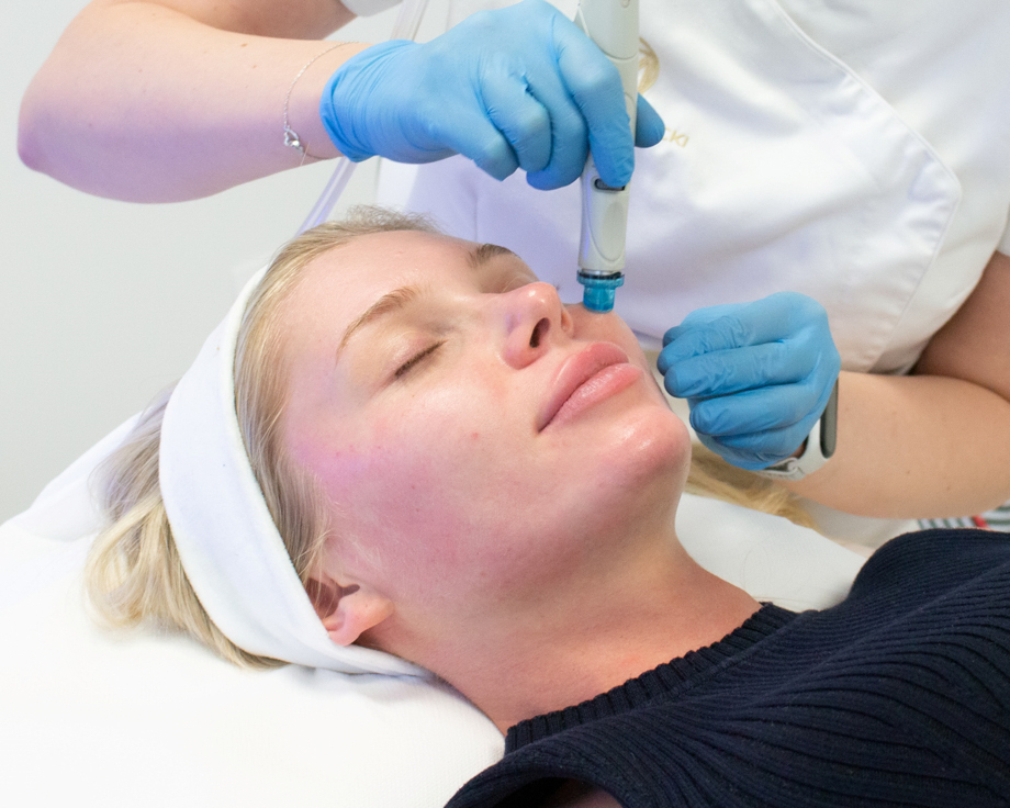 Jak wygląda twarz po mikrodermabrazji?